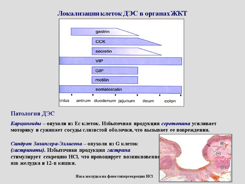 Локализация клеток ДЭС в органах ЖКТ   Карциноиды – опухоли из Ес клеток.